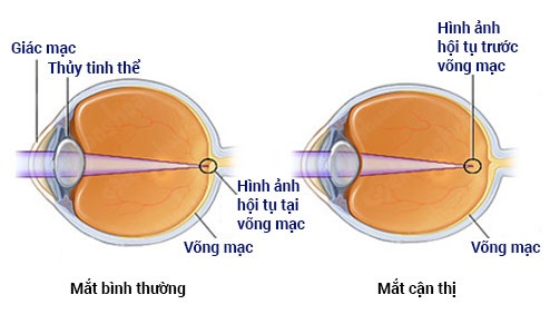 Chữa cận thị trở nên phổ biến trong thời gian gần đây