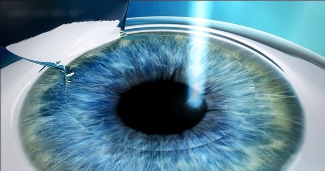Phẫu thuật Lasik là một phương pháp chữa cận thị cơ bản