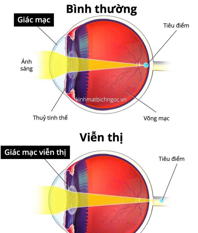 Hình ảnh phân biệt mắt bình thường và mắt viễn thị