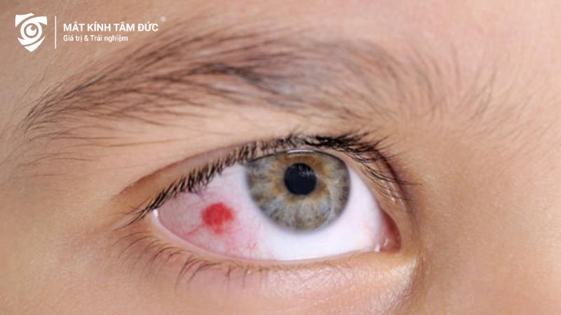 Xước giác mạc khi dụi mắt quá nhiều, tạo ra tình trạng sưng mắt, vệt máu trong mắt