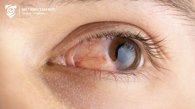 Dụi mắt khiến tình trạng tăng nhãn áp trở nên nghiêm trọng hơn
