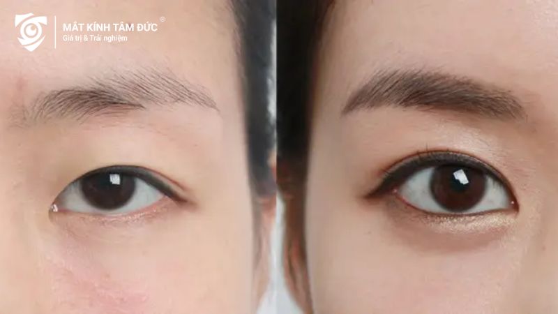 Phẫu thuật thẩm mỹ là cách cải thiện sự tự tin của người có đôi mắt lươn