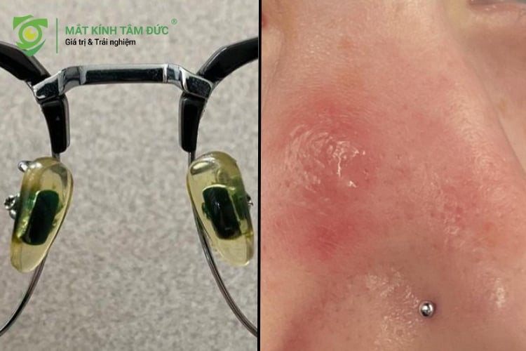 Đeo kính của người khác có lây bệnh không, tác hại khi dùng chung kính mắt gây mụn bọc và viêm da vùng mũi.