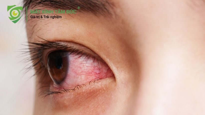 Tác hại bụi mịn lên giác mạc: mắt kính giúp hạn chế tổn thương