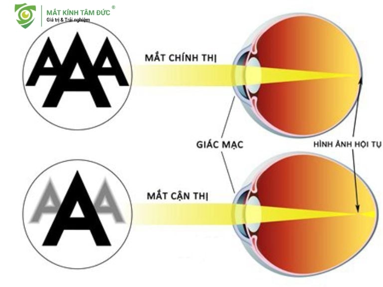 Sơ đồ so sánh mắt nhìn rõ (Mắt Chính thị) và mắt nhìn mờ (Mắt Cận thị) do ảnh hội tụ trước võng mạc