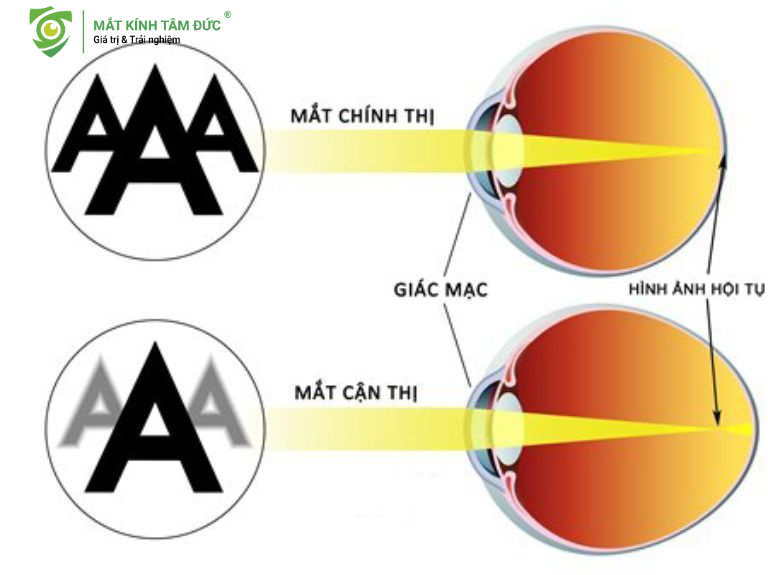 Sơ đồ so sánh mắt nhìn rõ (Mắt Chính thị) và mắt nhìn mờ (Mắt Cận thị) do ảnh hội tụ trước võng mạc