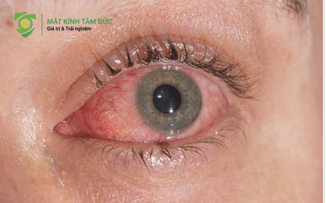 Đau mắt đỏ là minh chứng rõ ràng nhất cho việc đeo kính của người khác có lây bệnh không.