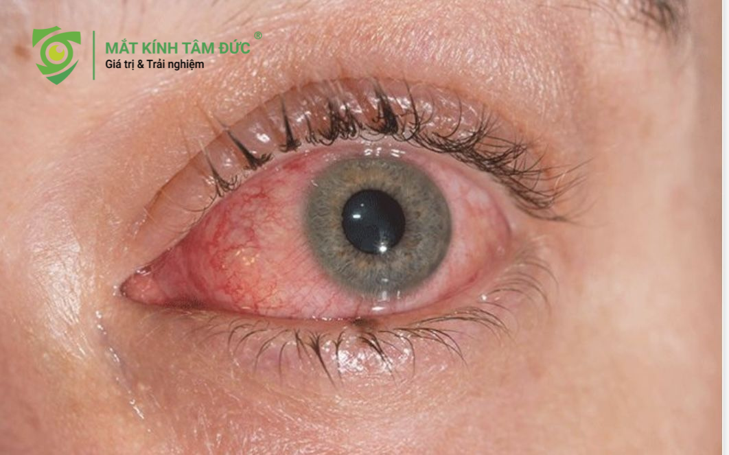Đau mắt đỏ là minh chứng rõ ràng nhất cho việc đeo kính của người khác có lây bệnh không.