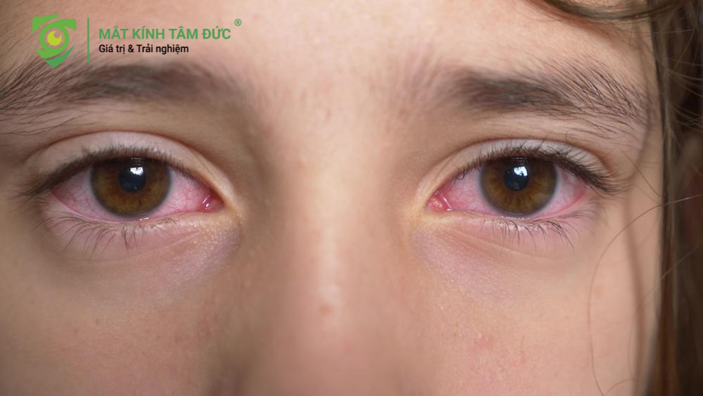 việc dùng chung kính cận vô tình trở thành con đường lây truyền vi khuẩn, virus nhanh chóng