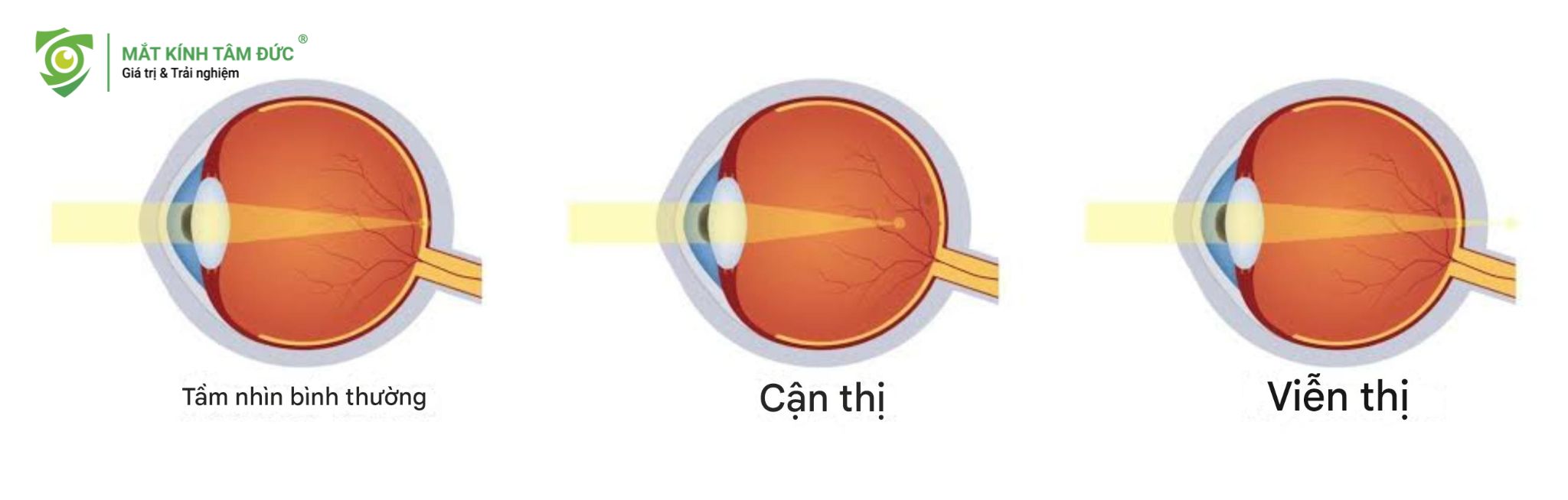 Cách phân biệt cận thị và viễn thị 