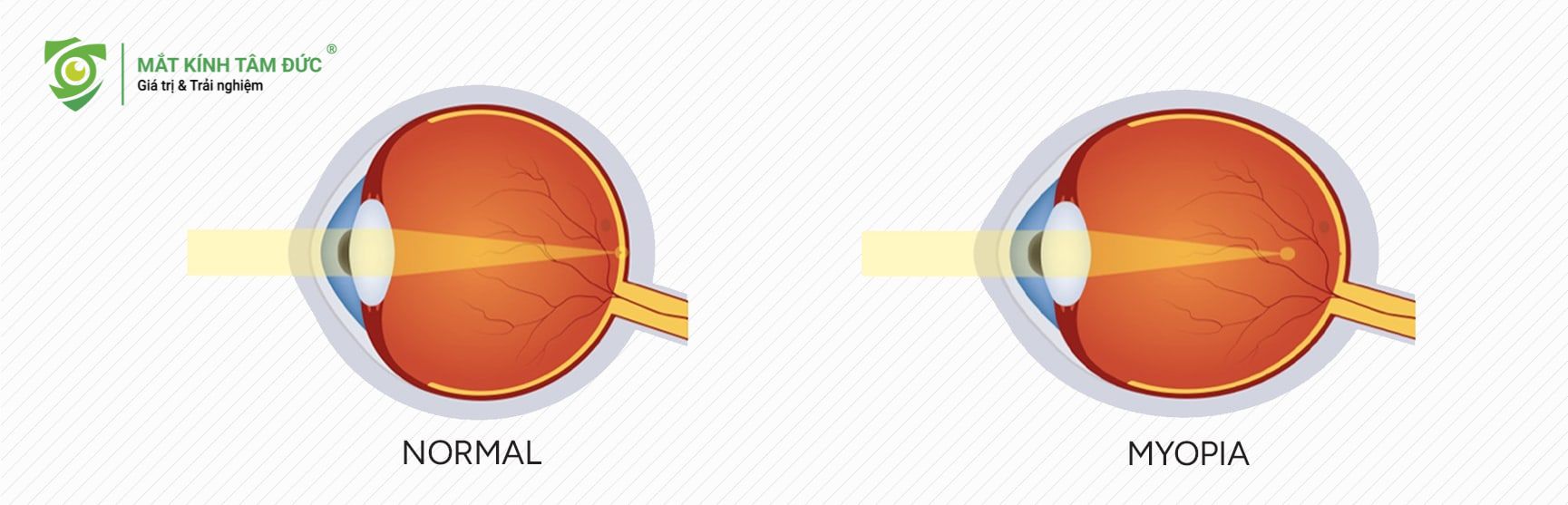 mức cận 3 độ (tương đương -3.00 Diop) không chỉ là một con số thông thường, mà chính là cột mốc phân chia quan trọng giữa cận thị nhẹ và cận thị trung bình