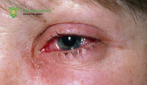 chảy nước mắt sống kéo dài không chỉ đơn thuần là sự khó chịu nhất thời mà còn gây ra nhiều hệ lụy cho đôi mắt