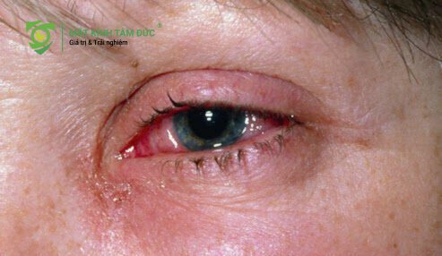 chảy nước mắt sống kéo dài không chỉ đơn thuần là sự khó chịu nhất thời mà còn gây ra nhiều hệ lụy cho đôi mắt