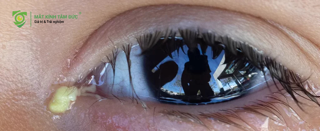 Chảy nước mắt sống kèm theo mủ hoặc ghèn đặc