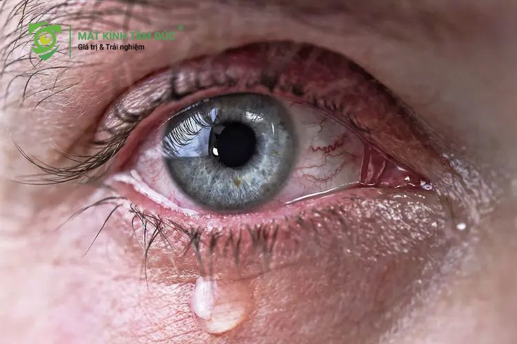 Chớp mắt liên tục để kích thích tuyến lệ khiến nước mắt tiết ra nhiều hơn sẽ giúp đẩy hạt bụi mịn