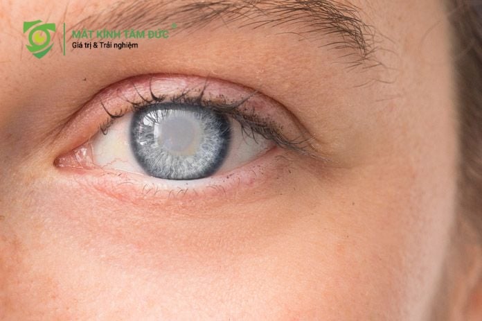 tác hại của tia uv làm đẩy nhanh quá trình đục thủy tinh thể