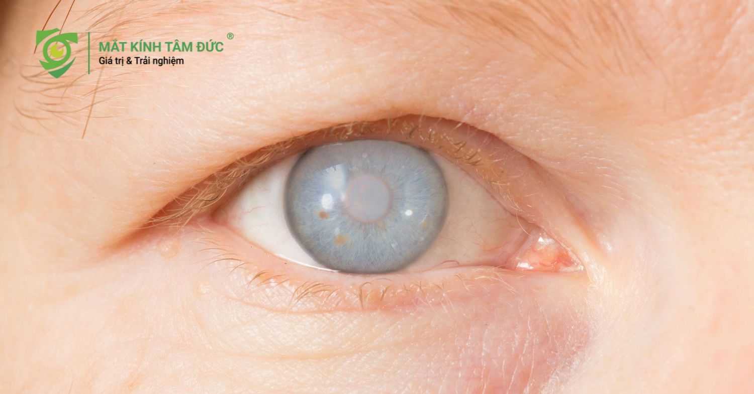 Cảnh báo bệnh lý nguy hiểm khi bị lóa mắt thường xuyên bị đục thủy tinh thể
