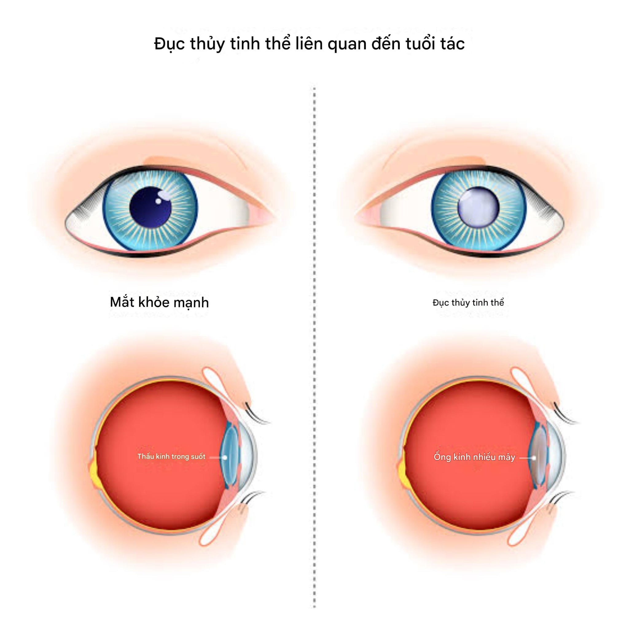 Đục thủy tinh thể sớm 
