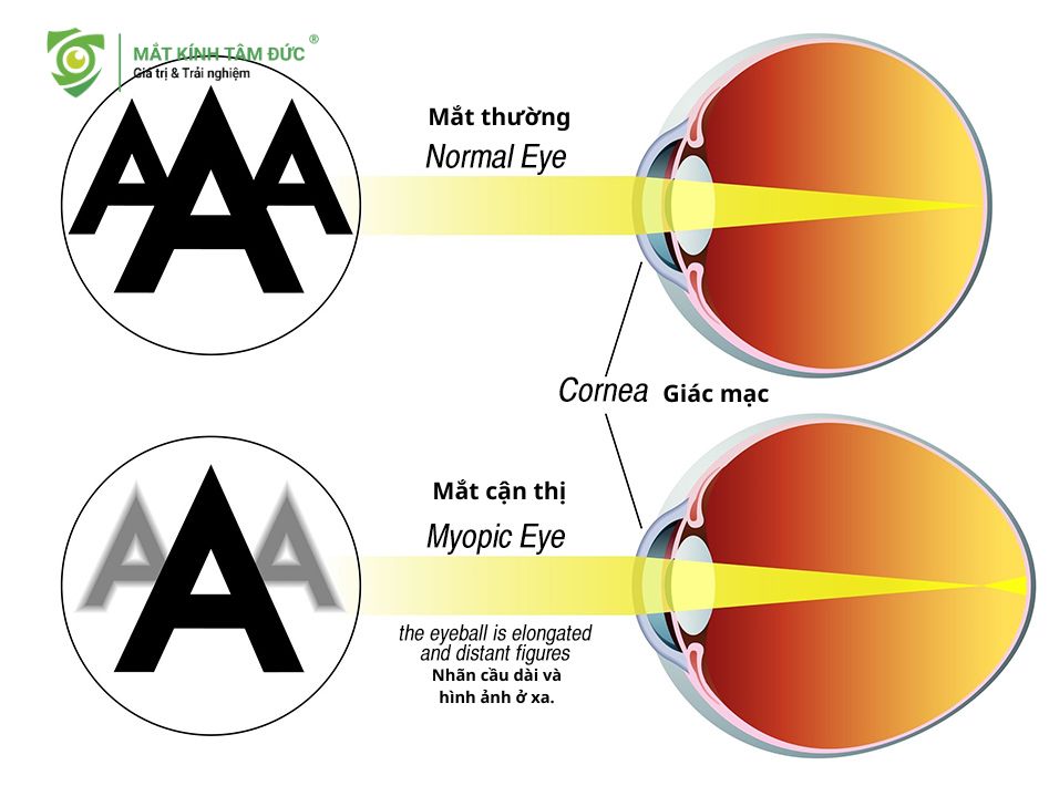 Cận thị (Myopia) – "Nhìn gần rõ, nhìn xa mờ"
