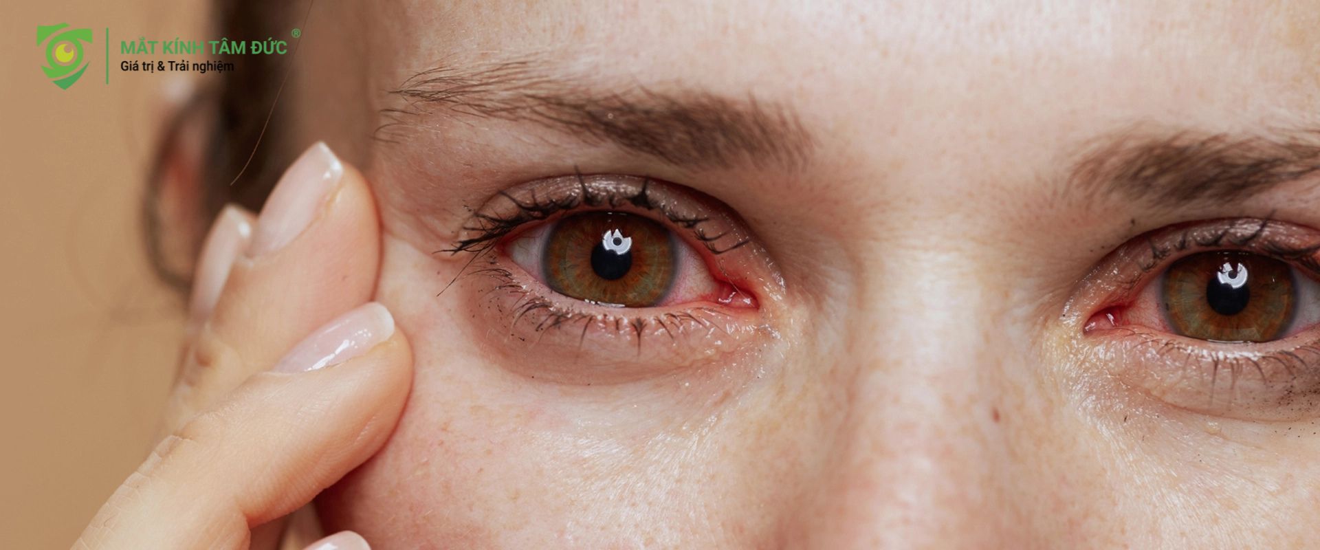 Khóc nhiều có tăng độ cận không?