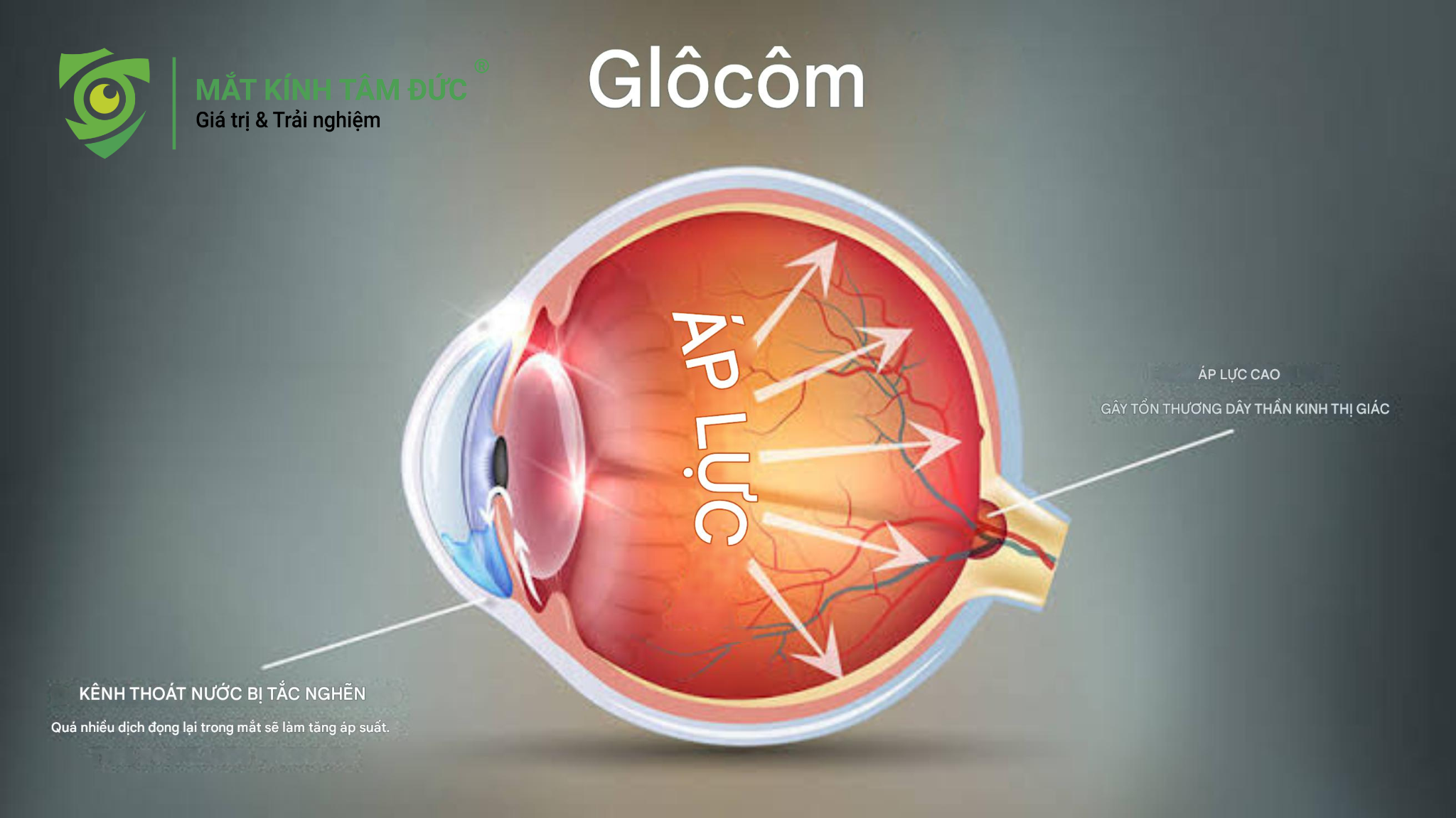 Người cận thị nặng có nguy cơ mắc bệnh Glôcôm cao gấp nhiều lần người bình thường.