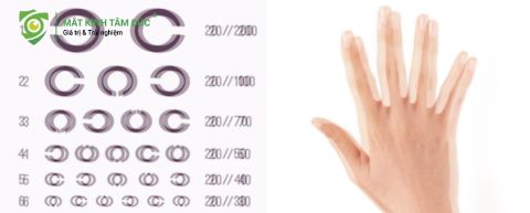 Mắt lác là gì? những biểu hiện như hiện tượng "Song thị" – Một vật bỗng hóa thành hai