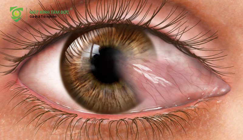 một trong những tác hại của tia uv hình thành mộng thịt và mộng mỡ