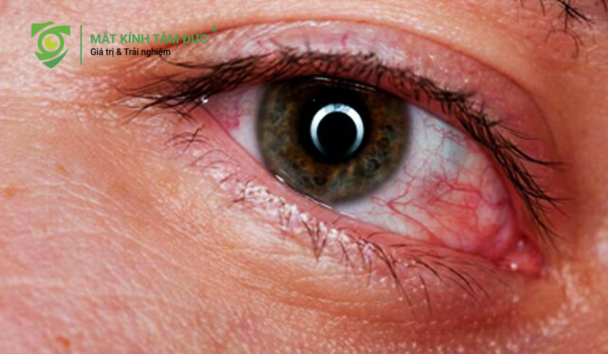 Hội chứng thị giác màn hình (CVS) và tổn thương võng mạc do ánh sáng xanh từ điện thoại.