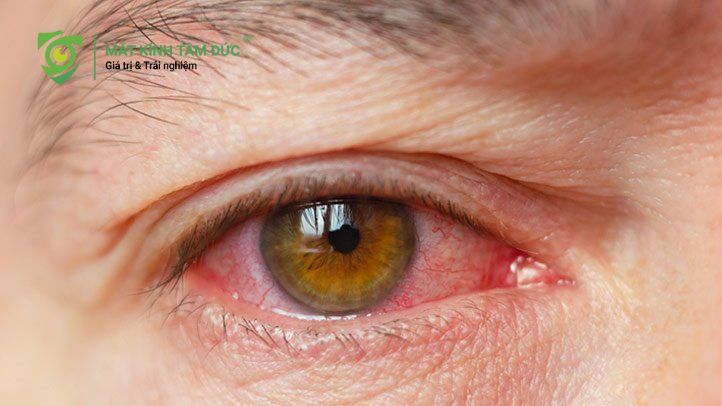 Khóc nhiều dẫn đến hội chứng Khô mắt