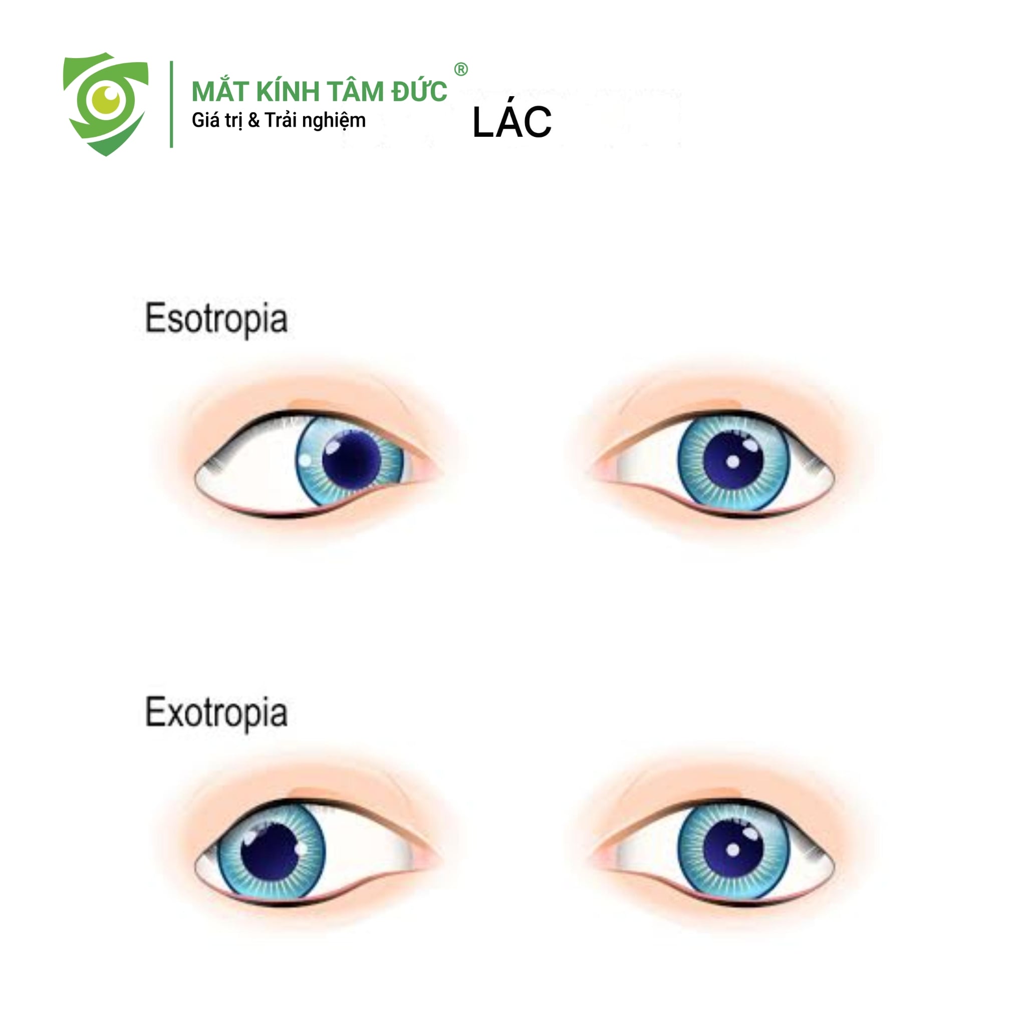 Lác (Lé) và Nhược thị 