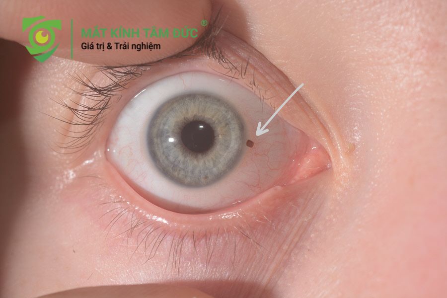 Những sai lầm tai hại khi xử lý bụi bay vào mắt không nên sử dụng các vật nhọn để lấy ra nên đến bác sĩ