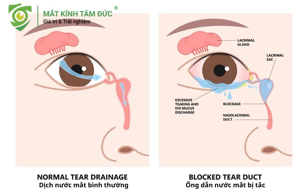 việc hiểu rõ bản chất của tình trạng chảy nước mắt sống sẽ giúp bạn có cách xử lý đúng đắn, tránh những biến chứng không đáng có