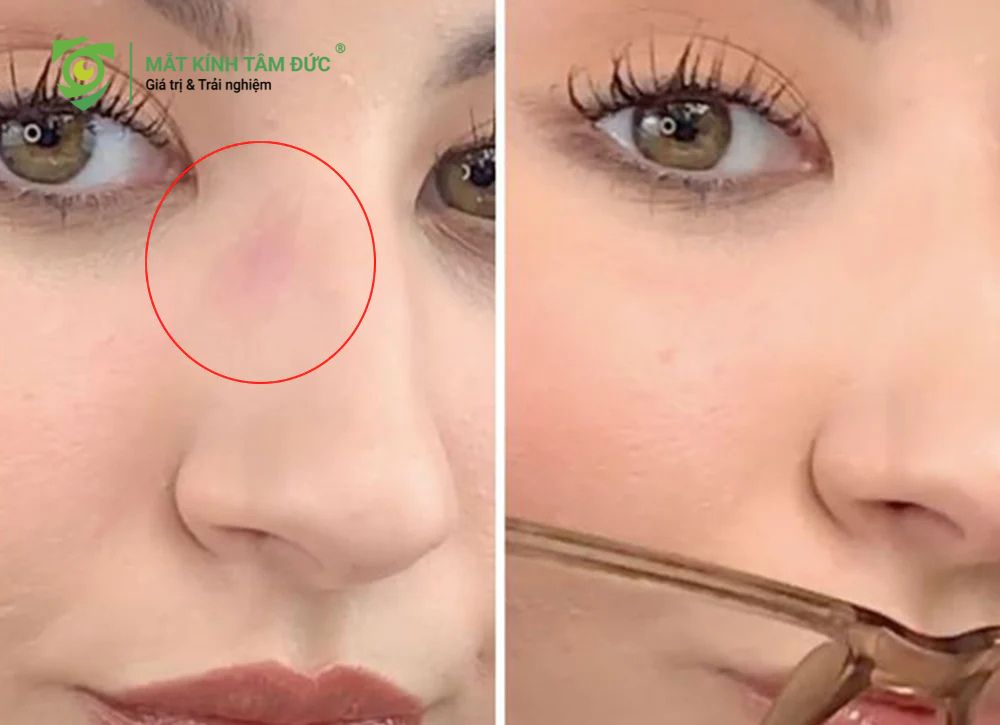 Tại sao makeup cho người đeo kính thường bị hằn ở mũi?