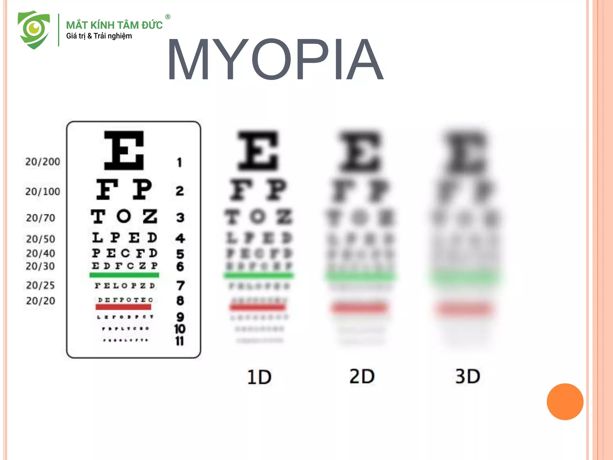 người cận 3 độ cảm thấy mọi thứ ở xa như bị phủ một lớp sương mù, trong khi các vật ở gần lại hiện lên rõ mượt vì ánh sáng hội tụ đúng điểm hơn.