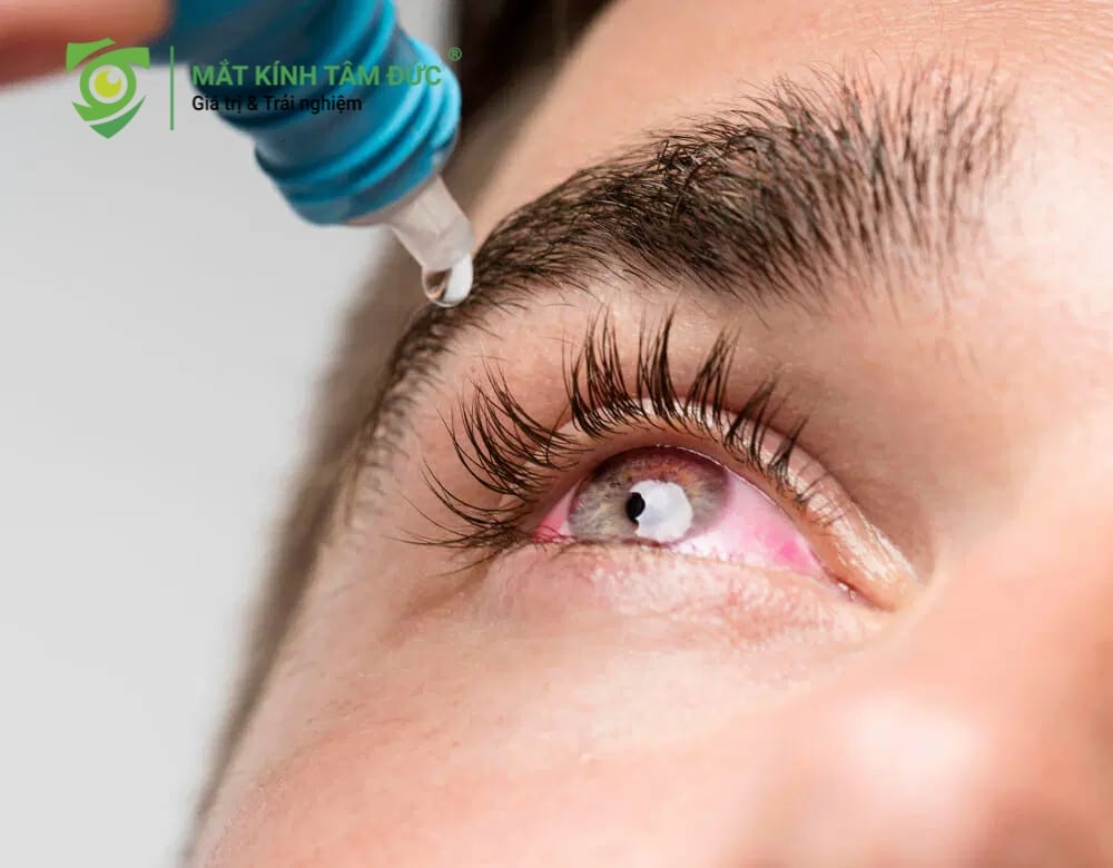 Vệ sinh mắt bằng nước muối sinh lý để rửa trôi hết bụi bẩn, vi khuẩn