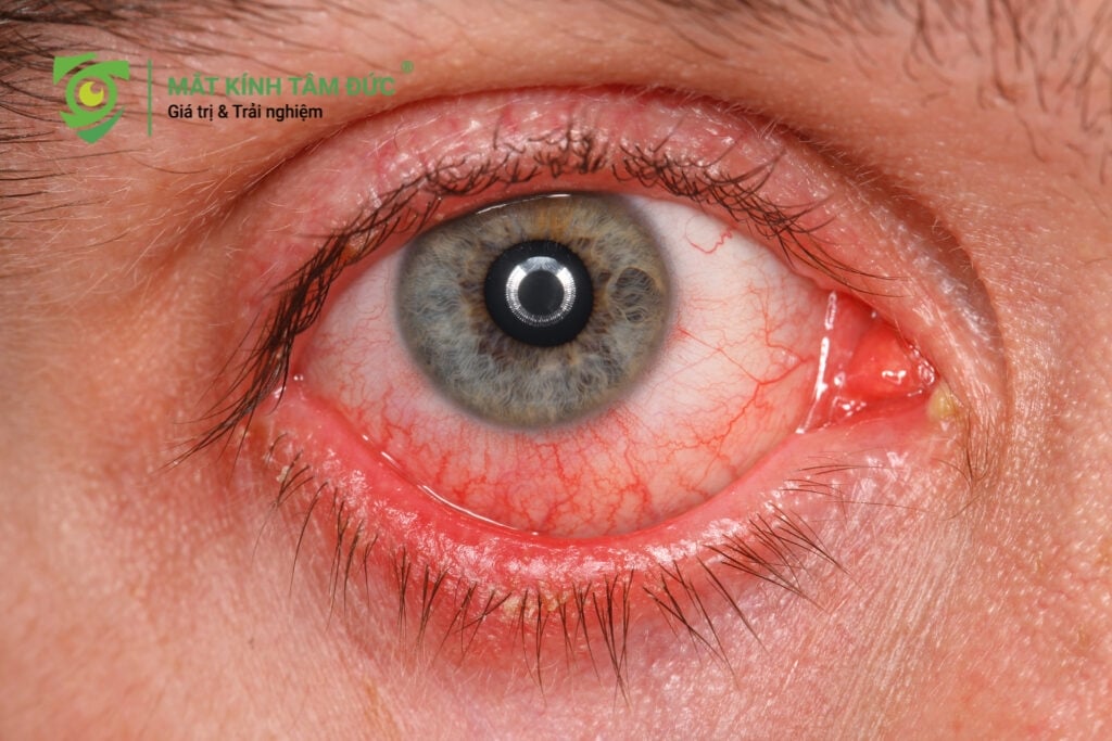 Viêm nhiễm nhãn khoa thường đi kèm với triệu chứng chảy nước mắt sống