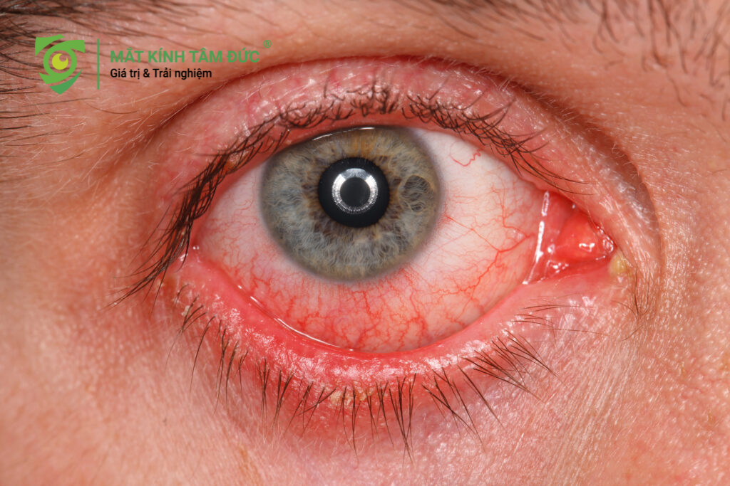 Viêm nhiễm nhãn khoa thường đi kèm với triệu chứng chảy nước mắt sống