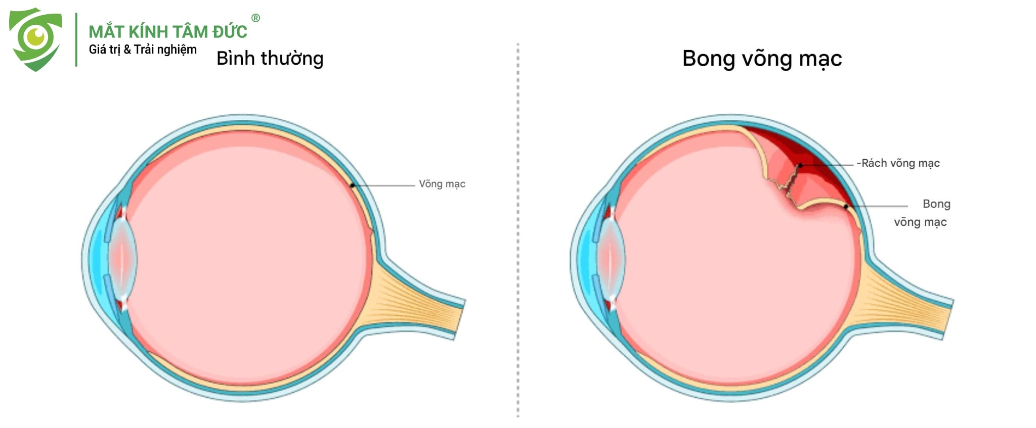Mô tả trực quan biến chứng bong võng mạc do các vết rách gây ra.