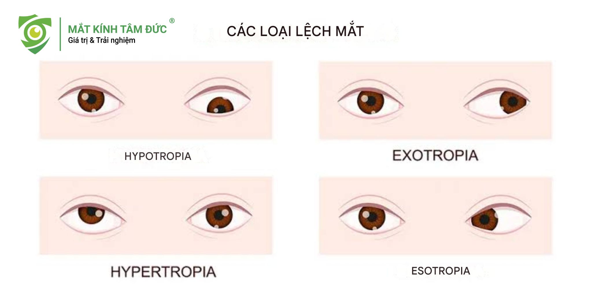Hình ảnh minh họa các loại mắt lác thường gặp: lác trong, lác ngoài, lác đứng