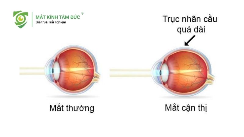 Trục nhãn cầu kéo dài khiến ánh sáng không hội tụ đúng võng mạc