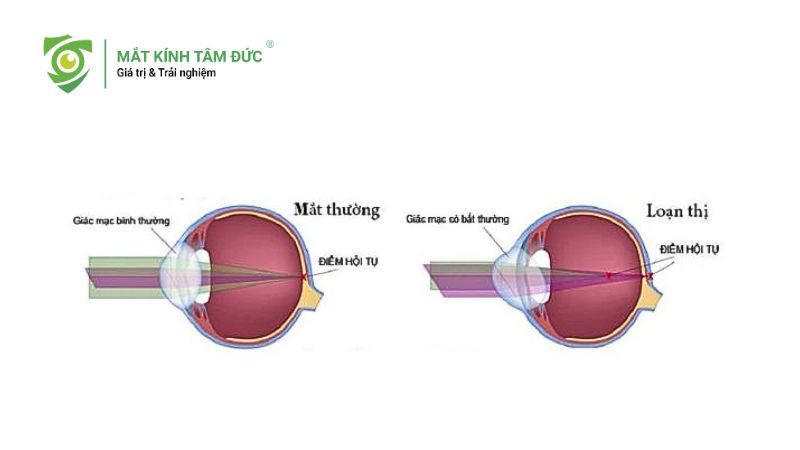 Loạn thị bẩm sinh là gì? Top 6 dấu hiệu cha mẹ tuyệt đối không nên bỏ qua