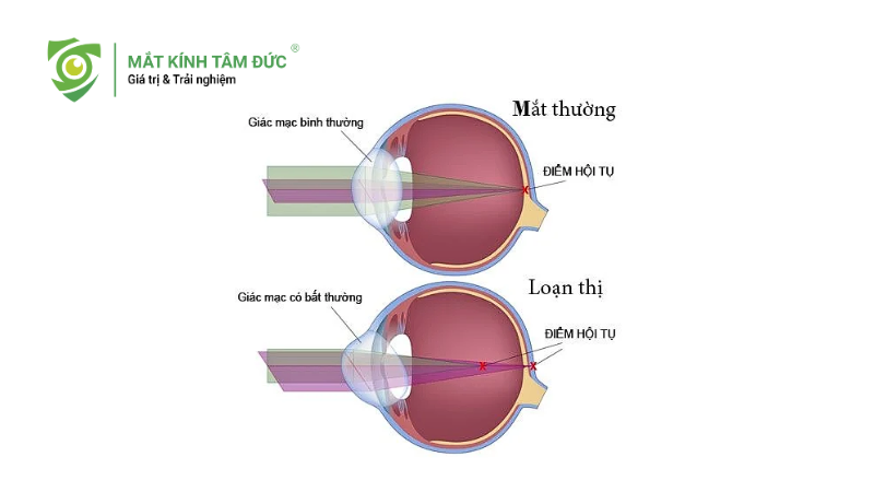 Người bị loạn thị có cần đeo kính không? Các mức độ của loạn thị