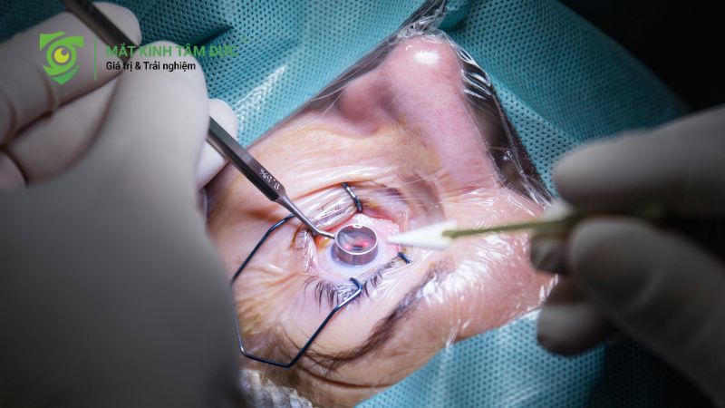 Mắt cận 10 độ có mổ được không? Ai đủ điều kiện và ai không nên mổ