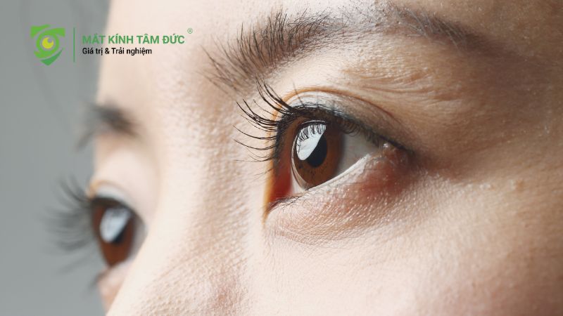 Mắt cận 10 độ có mổ được không? Ai đủ điều kiện và ai không nên mổ