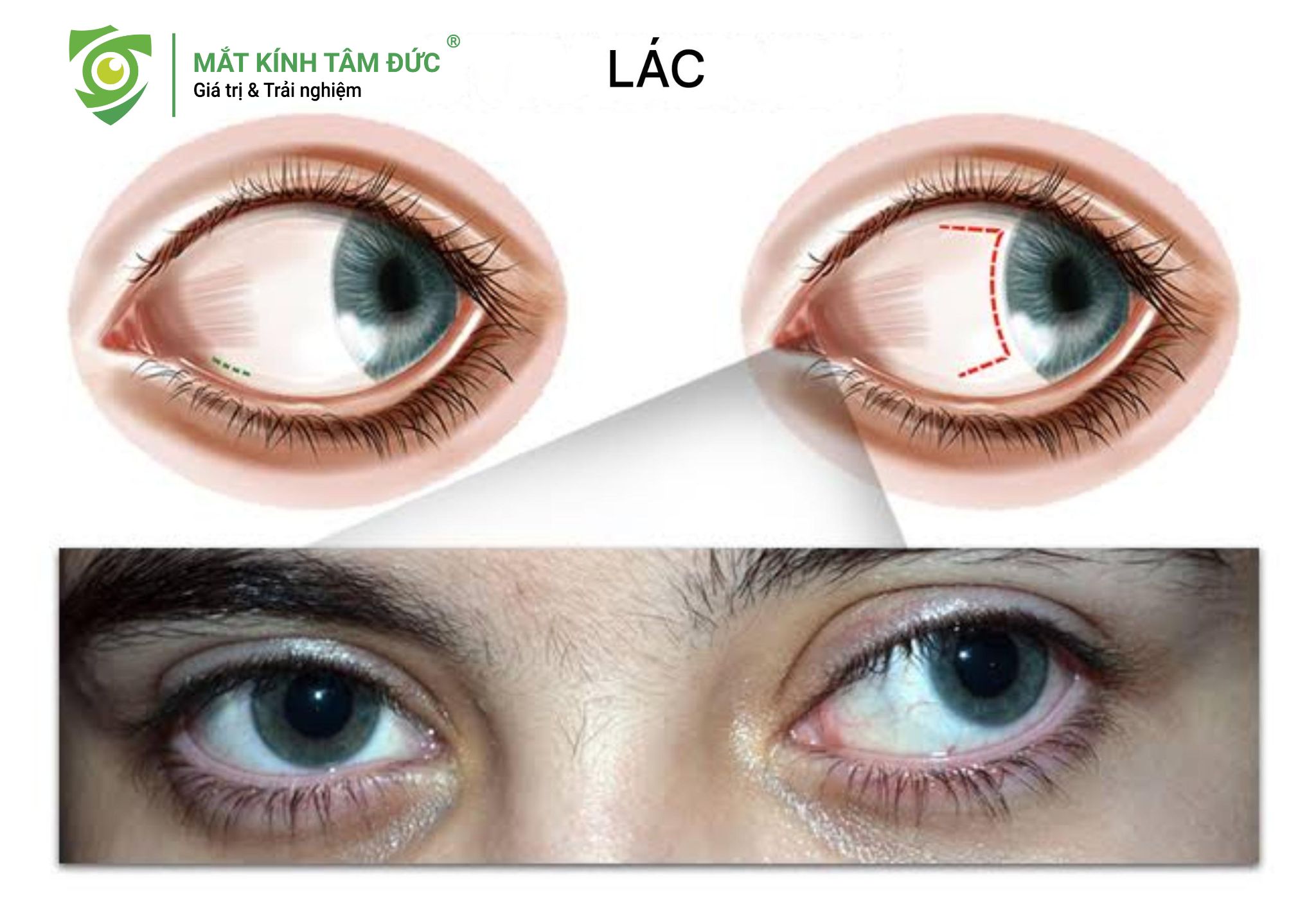 Nguyên nhân và dấu hiệu nhận biết sớm về mắt lác