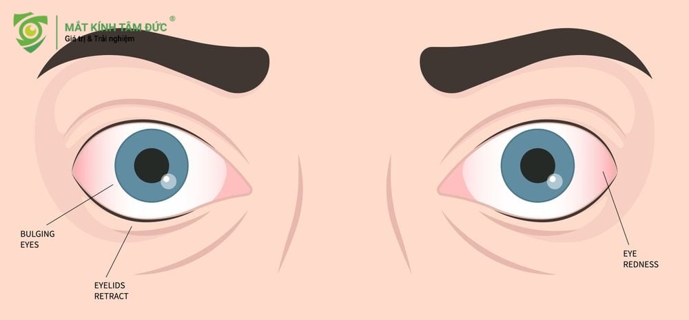 Đeo kính cận nhiều có bị lồi mắt không?