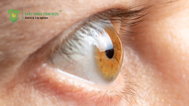 Tại sao nhiều người lầm tưởng đeo kính cận bị lồi mắt?