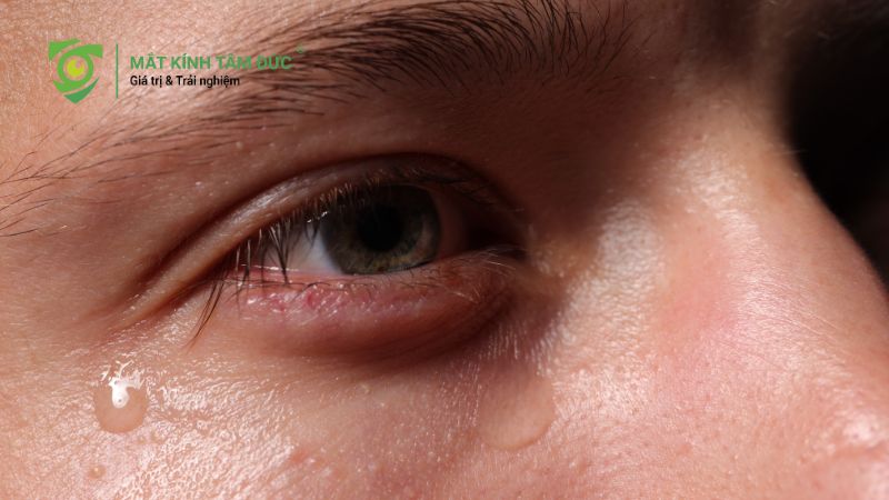 Mắt nhìn gần bị nhòe là bệnh gì? Cảnh báo các bệnh lý mắt thường gặp