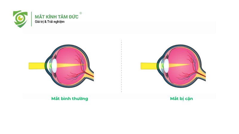 Mắt nhìn gần bị nhòe là bệnh gì? Cảnh báo các bệnh lý mắt thường gặp