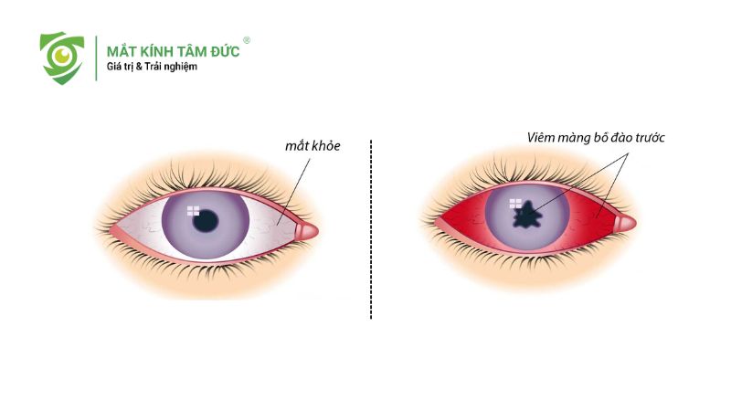 Mắt nhìn gần bị nhòe là bệnh gì? Cảnh báo các bệnh lý mắt thường gặp
